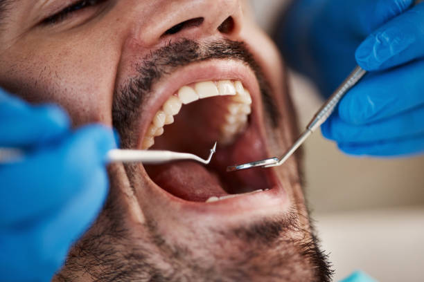 Best Emergency Tooth Extraction in Southchase, FL